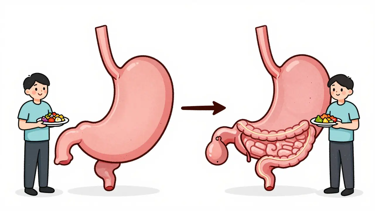 Bariatric Surgery: Gastric Bypass vs. Sleeve Gastrectomy - What You Really Need to Know
